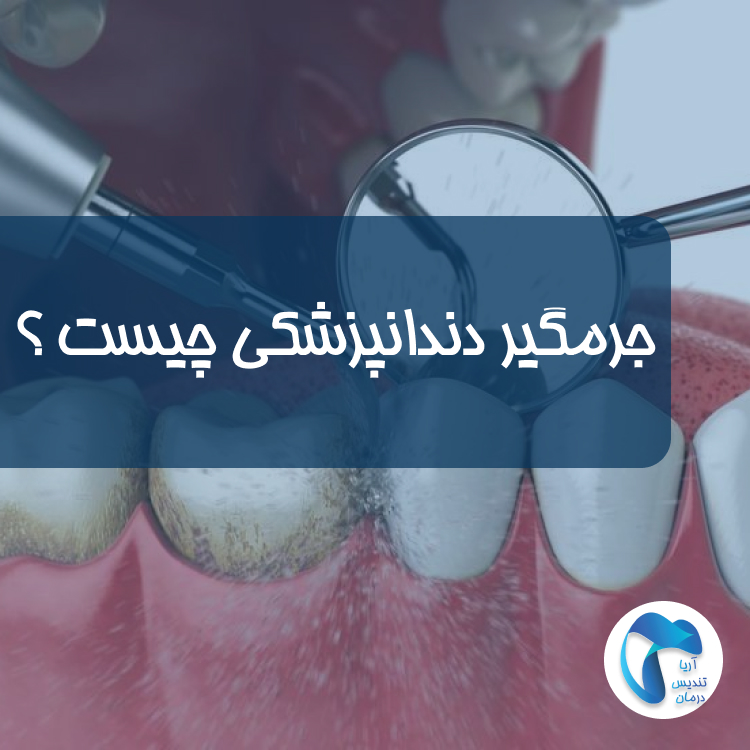 جرمگیر دندانپزشکی چیست؟